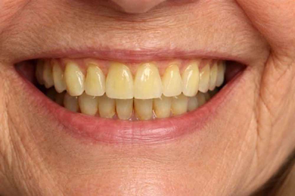 Emergency Denture Repairs